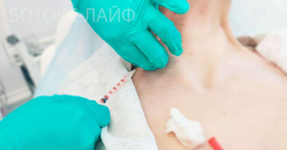 Ботокс в шею от морщин