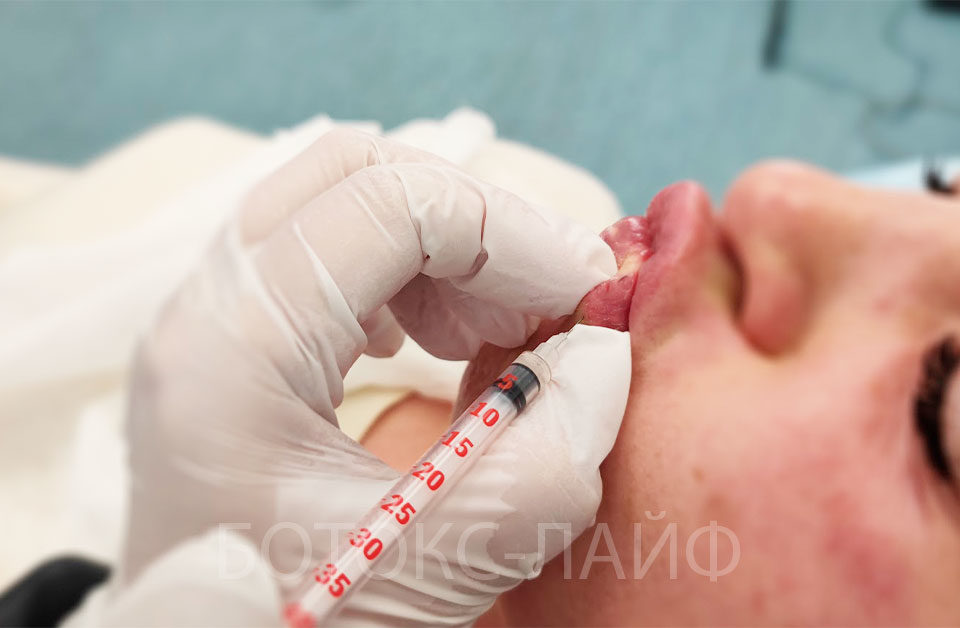 Ботокс для губ сколько единиц нужно