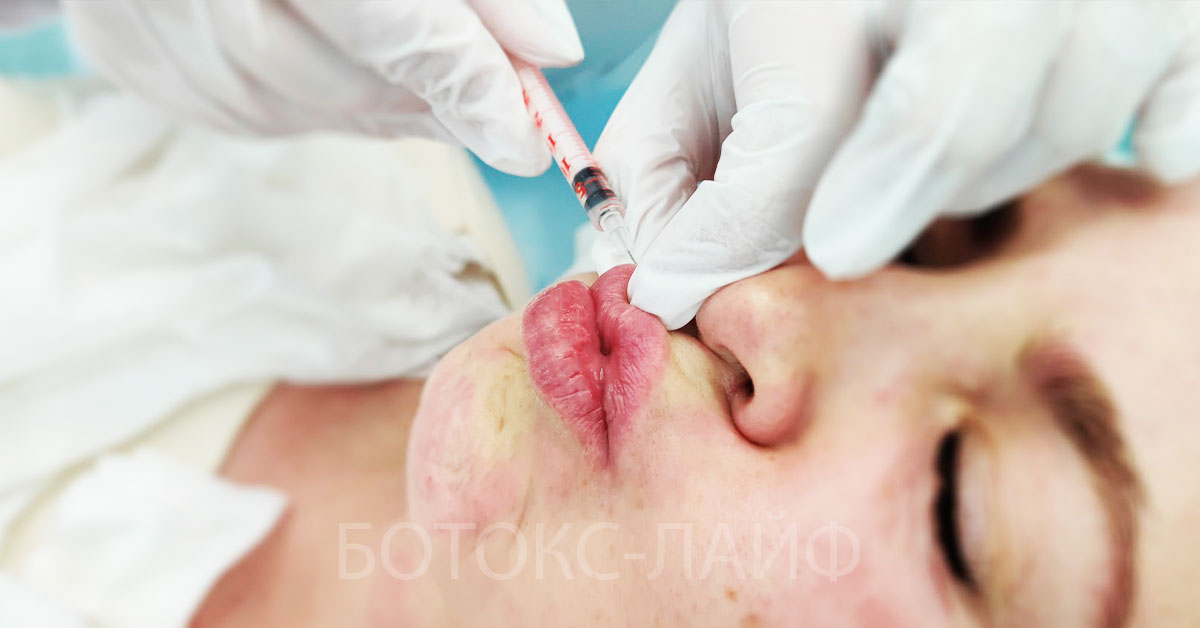 Ботокс для губ сколько единиц нужно