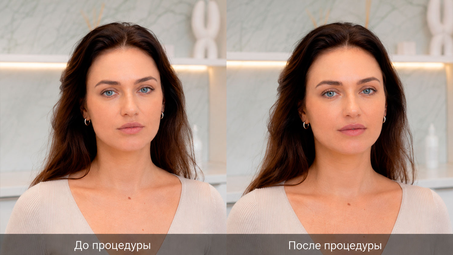 Фото до и после коррекции губ ботоксом с деликатным эффектом lip flip
