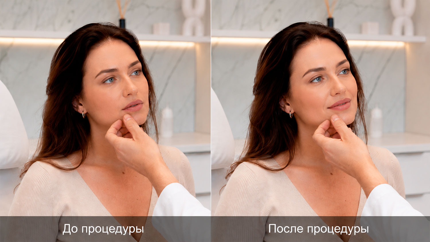 Фото до и после коррекции губ ботоксом с естественным результатом